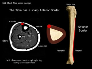 Anterior
The Tibia has a sharp Anterior Border
Mid-Shaft Tibia cross-section
Posterior
Anterior
Border
lateral view
MRI of cross-section through right leg
Looking up towards the head
anterior
posterior
medial
lateral
 