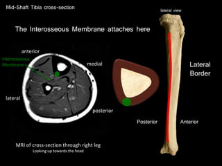 Anterior
Mid-Shaft Tibia cross-section
Posterior
Lateral
Border
lateral view
MRI of cross-section through right leg
Looking up towards the head
anterior
posterior
medial
lateral
The Interosseous Membrane attaches here
Interrosseous
Membrane
 