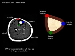 Mid-Shaft Tibia cross-section
MRI of cross-section through right leg
Looking up towards the head
anterior
posterior
medial
lateral
Anterior
border
Posterior
border
Lateral
border
 