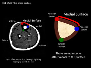 Mid-Shaft Tibia cross-section
MRI of cross-section through right leg
Looking up towards the head
anterior
posterior
medial
lateral
Anterior
border
Posterior
border
Lateral
border
Medial Surface
There are no muscle
attachments to this surface
Medial Surface
 