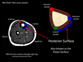 Mid-Shaft Tibia cross-section
MRI of cross-section through right leg
Looking up towards the head
anterior
posterior
medial
lateral
Anterior
border
Posterior
border
Lateral
border
Posterior Surface
Also known as the
Flexor Surface
 