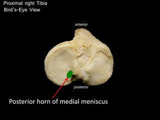 posterior
anterior
Proximal right Tibia
Posterior horn of medial meniscus
Bird’s-Eye View
 