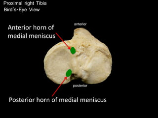 posterior
anterior
Posterior horn of medial meniscus
Anterior horn of
medial meniscus
Proximal right Tibia
Bird’s-Eye View
 