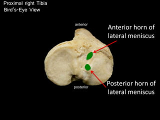 posterior
anterior
Posterior horn of
lateral meniscus
Anterior horn of
lateral meniscus
Proximal right Tibia
Bird’s-Eye View
 