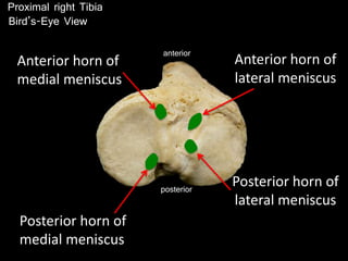 posterior
anterior
Posterior horn of
lateral meniscus
Anterior horn of
lateral meniscus
Posterior horn of
medial meniscus
Anterior horn of
medial meniscus
Proximal right Tibia
Bird’s-Eye View
 