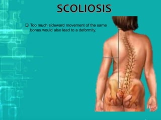  Too much sideward movement of the same
bones would also lead to a deformity.
 