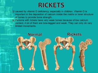  caused by vitamin D deficiency, especially in children. Vitamin D is
important in the deposition of calcium inside the matrix or inner structure
of bones to provide bone strength.
 Persons with rickets have very weak bones because of low calcium
content. A lot of them are bow-legged and weak. They can only do very
limited movements.
 