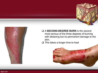  A SECOND-DEGREE BURN is the second
most serious of the three degrees of burning
with blistering but no permanent damage to the
skin.
 This takes a longer time to heal
 