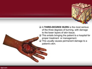  A THIRD-DEGREE BURN is the most serious
of the three degrees of burning, with damage
to the lower layers of skin tissue.
 This entails bringing the patient to a hospital for
proper treatment or management.
 This usually causes permanent damage to a
patient’s skin.
 