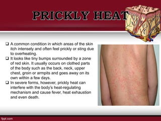  A common condition in which areas of the skin
itch intensely and often feel prickly or sting due
to overheating.
 It looks like tiny bumps surrounded by a zone
of red skin. It usually occurs on clothed parts
of the body such as the back, neck, upper
chest, groin or armpits and goes away on its
own within a few days.
 In severe forms, however, prickly heat can
interfere with the body’s heat-regulating
mechanism and cause fever, heat exhaustion
and even death.
 