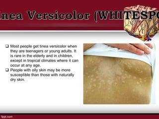  Most people get tinea versicolor when
they are teenagers or young adults. It
is rare in the elderly and in children,
except in tropical climates where it can
occur at any age.
 People with oily skin may be more
susceptible than those with naturally
dry skin.
 