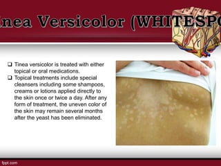 Tinea versicolor is treated with either
topical or oral medications.
 Topical treatments include special
cleansers including some shampoos,
creams or lotions applied directly to
the skin once or twice a day. After any
form of treatment, the uneven color of
the skin may remain several months
after the yeast has been eliminated.
 