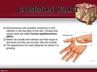  Noncancerous skin growths caused by a viral
infection in the top layer of the skin. Viruses that
cause warts are called human papillomavirus
(HPV).
 Warts are usually skin-colored and feel rough to
the touch but they can be dark, flat and smooth.
 The appearance of a wart depends on where it is
growing.
 
