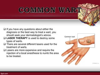  If you have any questions about either the
diagnosis or the best way to treat a wart, you
should seek your dermatologist’s advice.
 LASER THERAPY is used to destroy some
types of warts.
 There are several different lasers used for the
treatment of warts.
 Lasers are more expensive and require the
injection of a local anesthesia to numb the area
to be treated.
 
