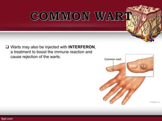  Warts may also be injected with INTERFERON,
a treatment to boost the immune reaction and
cause rejection of the warts.
 