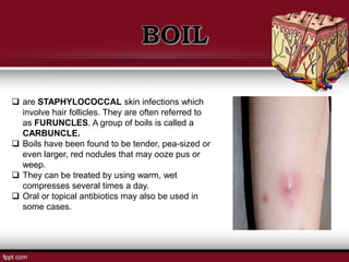  are STAPHYLOCOCCAL skin infections which
involve hair follicles. They are often referred to
as FURUNCLES. A group of boils is called a
CARBUNCLE.
 Boils have been found to be tender, pea-sized or
even larger, red nodules that may ooze pus or
weep.
 They can be treated by using warm, wet
compresses several times a day.
 Oral or topical antibiotics may also be used in
some cases.
 
