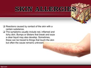  Reactions caused by contact of the skin with a
certain substance.
 The symptoms usually include red, inflamed and
itchy skin. Bumps or blisters that break and ooze
a clear liquid may also develop. Sometimes,
these can be traced to things that touch the skin
but often the cause remains unknown.
 