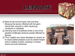  Most at risk are the hands, feet and face.
Because the person affected with the germ
cannot feel, wounds or other injuries go
unnoticed or untreated.
 Life-long care of anesthetic limbs is one of the
greatest challenges faced by people affected by
leprosy.
 Thus, neglect can cause damages so severe as
to cause partial paralysis such as clawed fingers
and an inability to blink, resulting in corneal
ulcers and even blindness.
 