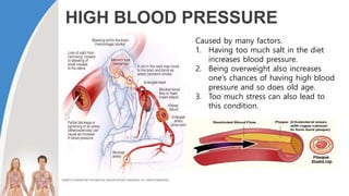 HIGH BLOOD PRESSURE
Caused by many factors.
1. Having too much salt in the diet
increases blood pressure.
2. Being overweight also increases
one’s chances of having high blood
pressure and so does old age.
3. Too much stress can also lead to
this condition.
 