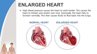 ENLARGED HEART
 High blood pressure causes the heart to work harder. This causes the
heart to thicken and stretch over time. Eventually, the heart fails to
function normally. This then causes fluids to flow back into the lungs.
 