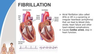 FIBRILLATION
 Atrial fibrillation (also called
AFib or AF) is a quivering or
irregular heartbeat (arrhythmia)
that can lead to blood clots,
stroke, heart failure and other
heart-related complications.
 Causes Cardiac arrest, stop in
heart function.
 