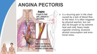 ANGINA PECTORIS
 is a recurring pain in the chest
caused by a lack of blood flow
to the heart. It is often triggered
by physical exertion, but can
also be brought on by extreme
heat and cold, heavy meals,
cigarette smoking, excessive
alcohol consumption and emo-
tional stress.
 
