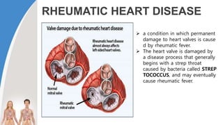 RHEUMATIC HEART DISEASE
 a condition in which permanent
damage to heart valves is cause
d by rheumatic fever.
 The heart valve is damaged by
a disease process that generally
begins with a strep throat
caused by bacteria called STREP
TOCOCCUS, and may eventually
cause rheumatic fever.
 