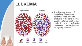 LEUKEMIA
 A malignancy (cancer) of
blood cells. In leukemia,
abnormal blood cells are
produced in the bone marrow.
 Usually, leukemia involves the
production of abnormal white
blood cells - cells responsible
for fighting infection.
 