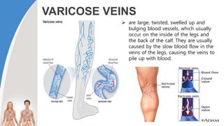 VARICOSE VEINS
 are large, twisted, swelled up and
bulging blood vessels, which usually
occur on the inside of the legs and
the back of the calf. They are usually
caused by the slow blood flow in the
veins of the legs, causing the veins to
pile up with blood.
 