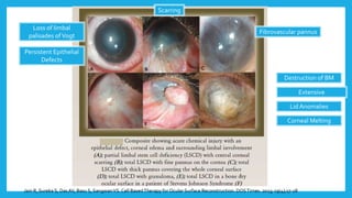 Jain R, Sureka S, DasAV, Basu S, SangwanVS. Cell BasedTherapy for Ocular Surface Reconstruction. DOSTimes. 2013; 19(4);17-28
Fibrovascular pannus
Persistent Epithelial
Defects
Loss of limbal
palisades ofVogt
Scarring
Extensive
symblepharon
Destruction of BM
Corneal Melting
Lid Anomalies
 