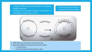 • 2 strips of limbal conjunctival grafts 6-7 limbal arc
lengths removed
• Lenticule  1 mm clear cornea + 1 mm limbus + 3
mm bulbar conjunctiva = 5 mm
• Lenticules sutured with 10-
0 nylon & 8-0 vicry sutures
 AMT patch can be used to cover lesion site
 Recommendation (to prevent donor site LSCD) –
 <6 clock hours
 Partial thickness limbal graft (40-60µ)
 
