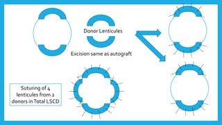 Excision same as autograft
Donor Lenticules
Suturing of 4
lenticules from 2
donors inTotal LSCD
 