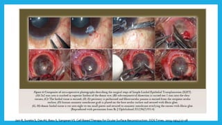 Jain R, Sureka S, DasAV, Basu S, SangwanVS. Cell BasedTherapy for Ocular Surface Reconstruction. DOSTimes. 2013; 19(4);17-28
 