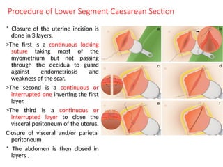 Lacking Procedur LSCS operation for pregnant mother types | PPTX