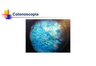 Colonoscopia
 