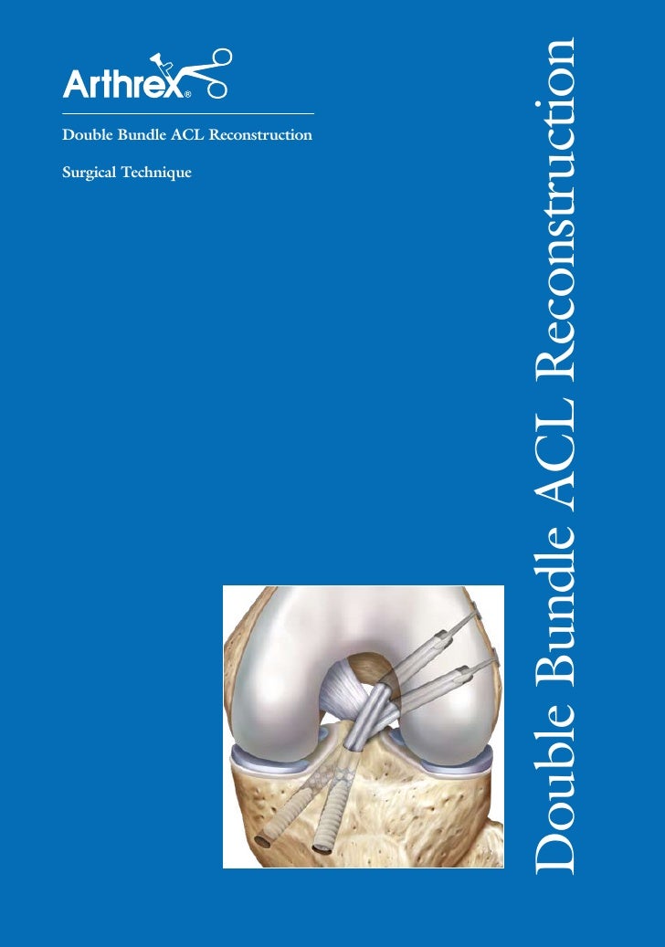 Lt0184 a double bundle acl