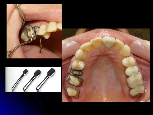 Linea terminal, Impresiones, Provisional | PPT