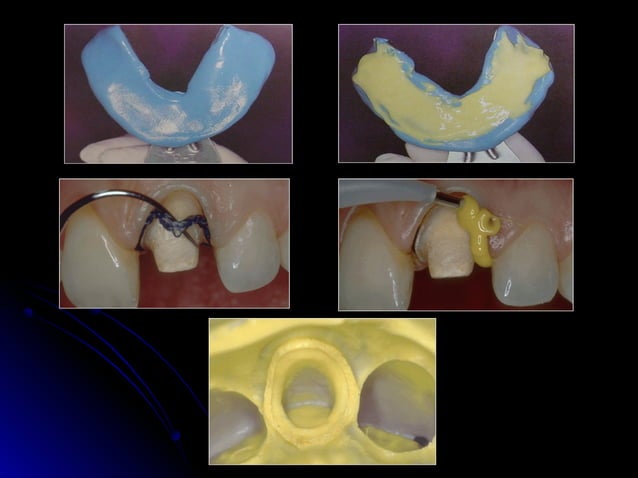 Linea terminal, Impresiones, Provisional | PPT