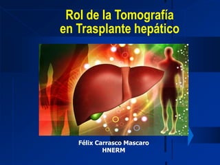 Rol de la Tomografía
en Trasplante hepático
Félix Carrasco Mascaro
HNERM
 