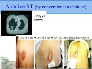Ablative RT (by conventional technique)

 