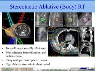 Stereotactic Ablative (Body) RT

 