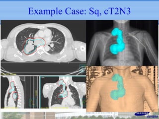Example Case: Sq, cT2N3

 