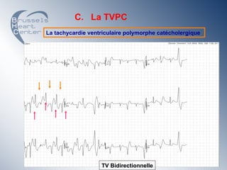 C. La TVPC
La tachycardie ventriculaire polymorphe catécholergique




                   TV Bidirectionnelle
 