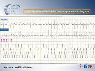 La tachycardie ventriculaire polymorphe catécholergique


A Tip-A Ring




V Tip- V Ring




      8 chocs du défibrillateur
 