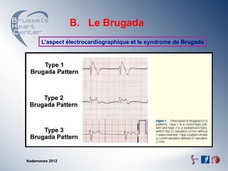 B. Le Brugada
      L’aspect électrocardiographique et le syndrome de Brugada




Nademanee 2012
 