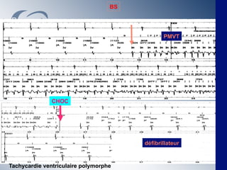 BS




                                               PMVT




               CHOC




                                        défibrillateur



Tachycardie ventriculaire polymorphe
 
