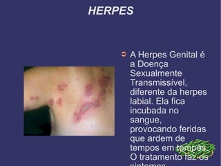 HERPES A Herpes Genital é a Doença Sexualmente Transmissível, diferente da herpes labial. Ela fica incubada no sangue, provocando feridas que ardem de tempos em tempos. O tratamento faz os sintomas desaparecerem, porém a herpes permanece no corpo e retorna em momentos de baixa imunidade ou estresse.  Só há transmissão da herpes quando há feridas ou bolhas, em períodos de incubação NÃO ocorre transmissão. 
