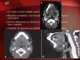 CT scan is most widely used modality
Readily available, can localize abscesses in the head
and neck
Not as effective as ultrasound in determining abscess
from cellulitis
Cellulitis  appears as soft-tissue swelling, increased
density of surrounding fat, enhancement of involved
muscles and obliteration of fat planes
Abscess  low density area with a peripheral
enhancement
CT has been reported to have sensitivity of 91% and
specifi city of 60%
CT
 