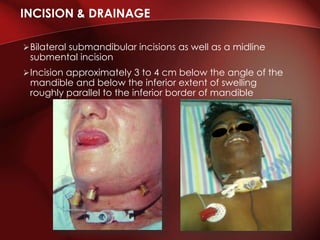 Bilateral submandibular incisions as well as a midline
submental incision
Incision approximately 3 to 4 cm below the angle of the
mandible and below the inferior extent of swelling
roughly parallel to the inferior border of mandible
INCISION & DRAINAGE
 