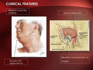 CLINICAL FEATURES
Bilateral wood like
swelling
Double chin
appearance
Elevation and protrusion of
tongue
Airway obstruction
 